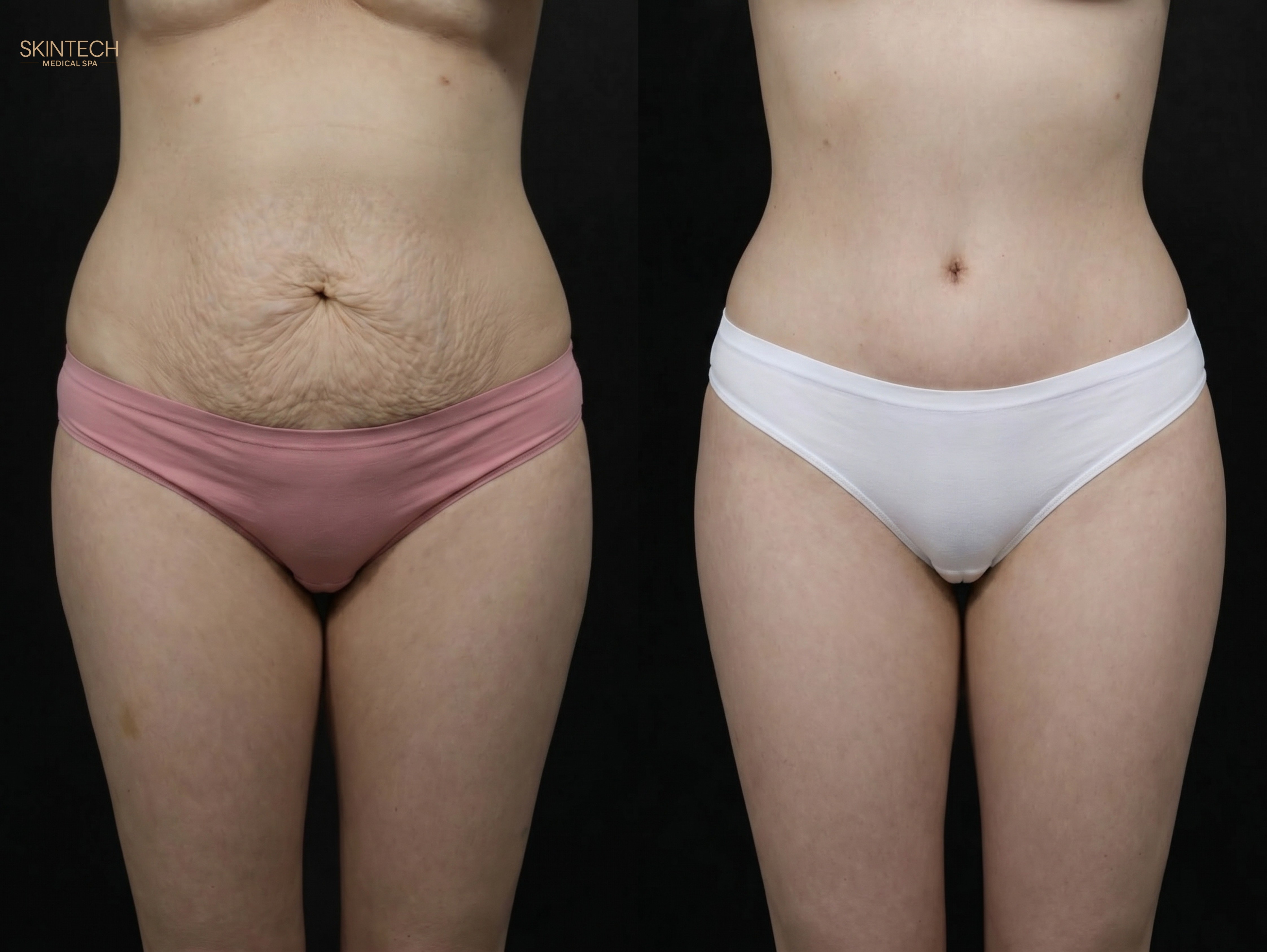 Mid-Section Makeover - Body Contouring (Bionexis) – Image 5