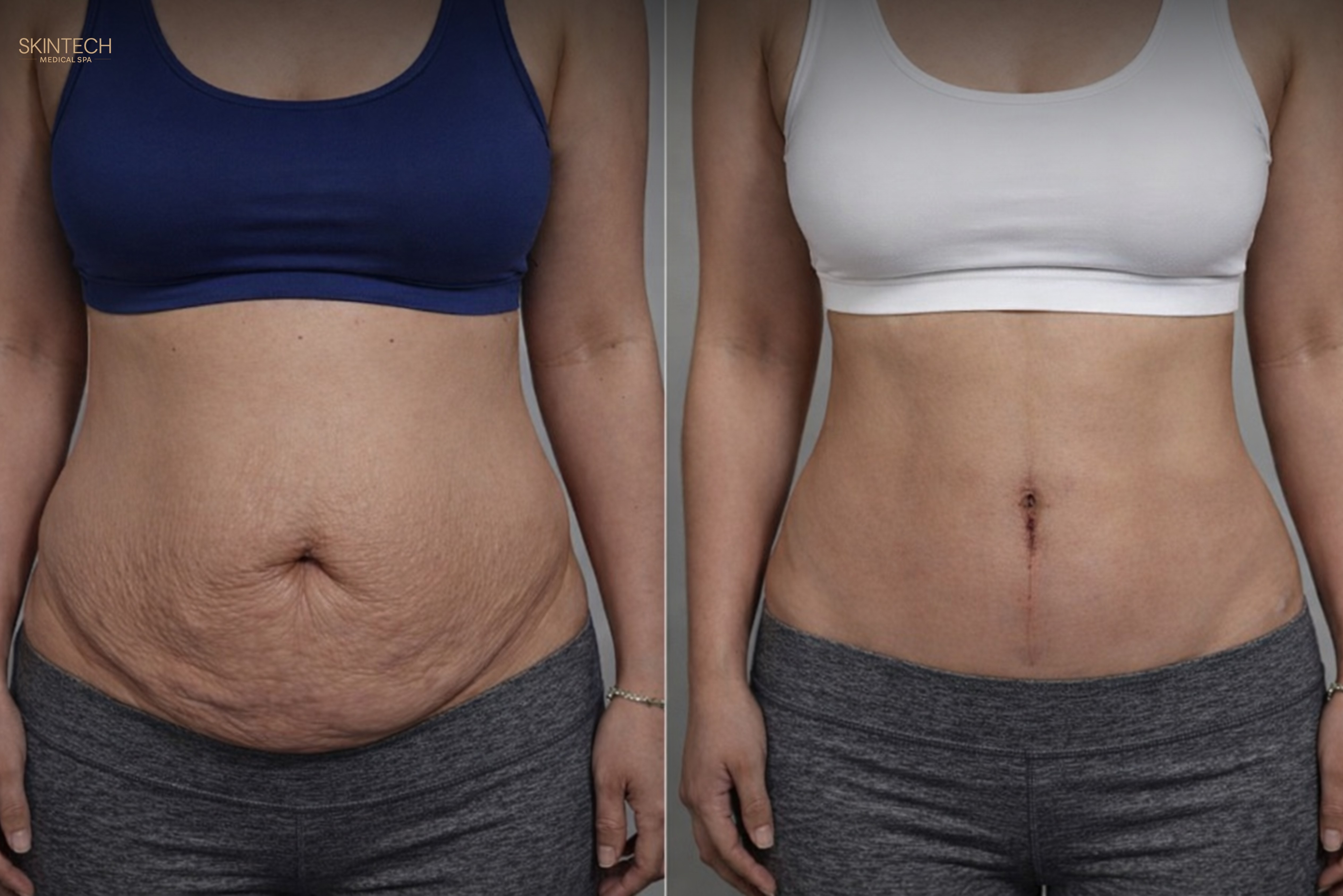Mid-Section Makeover - Body Contouring (Bionexis) – Image 2