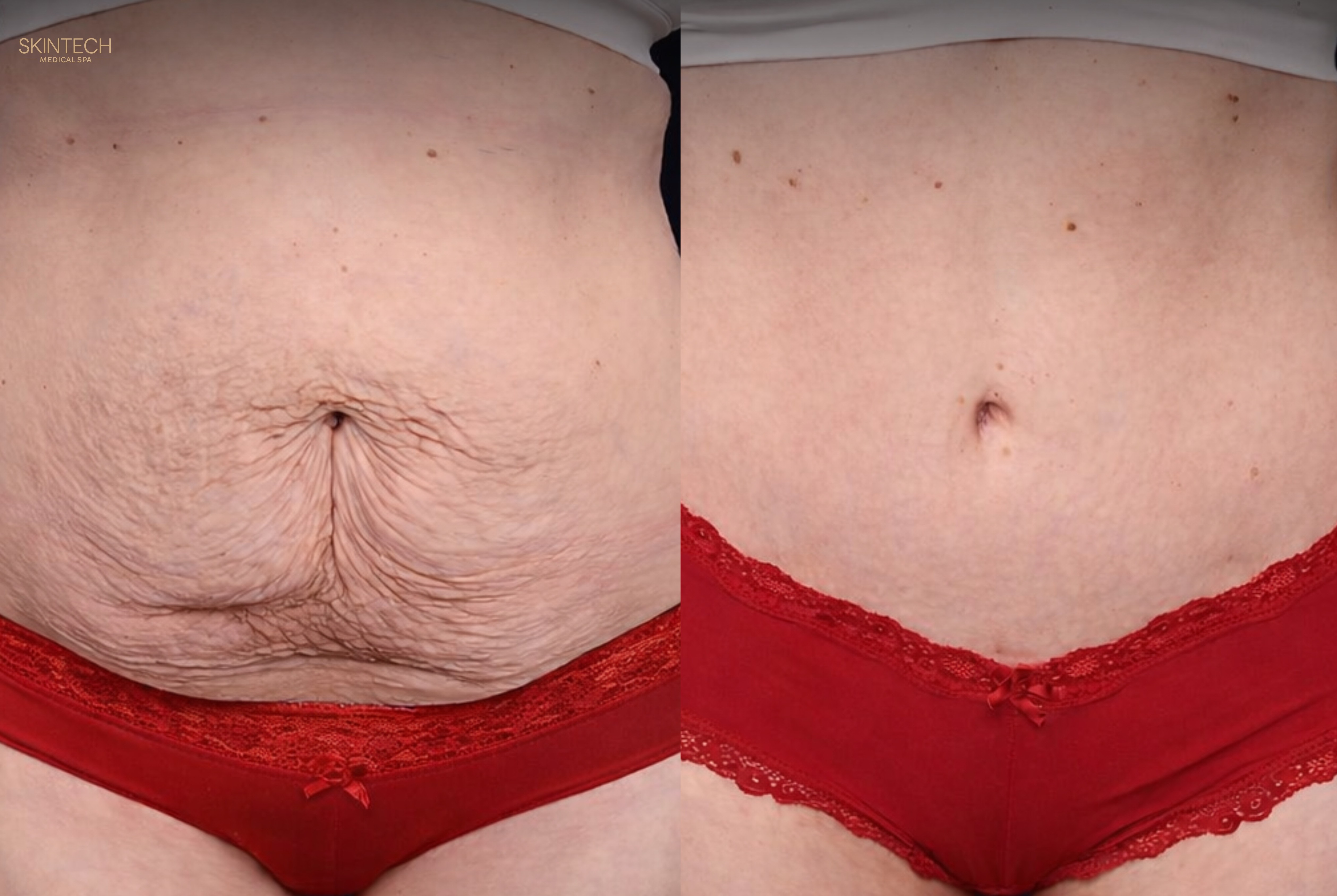 Mid-Section Makeover - Body Contouring (Bionexis) – Image 6