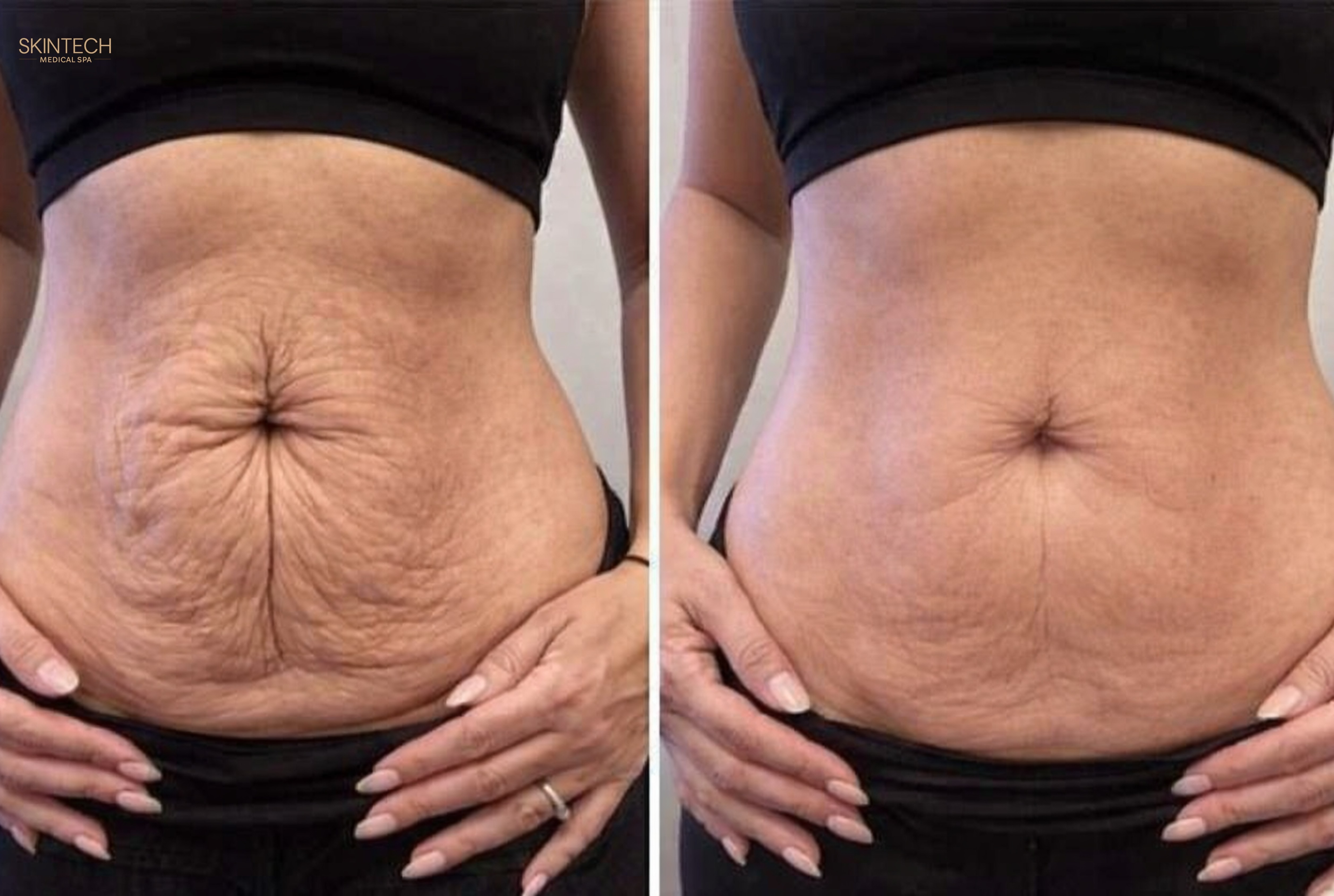 Mid-Section Makeover - Body Contouring (Bionexis) – Image 3