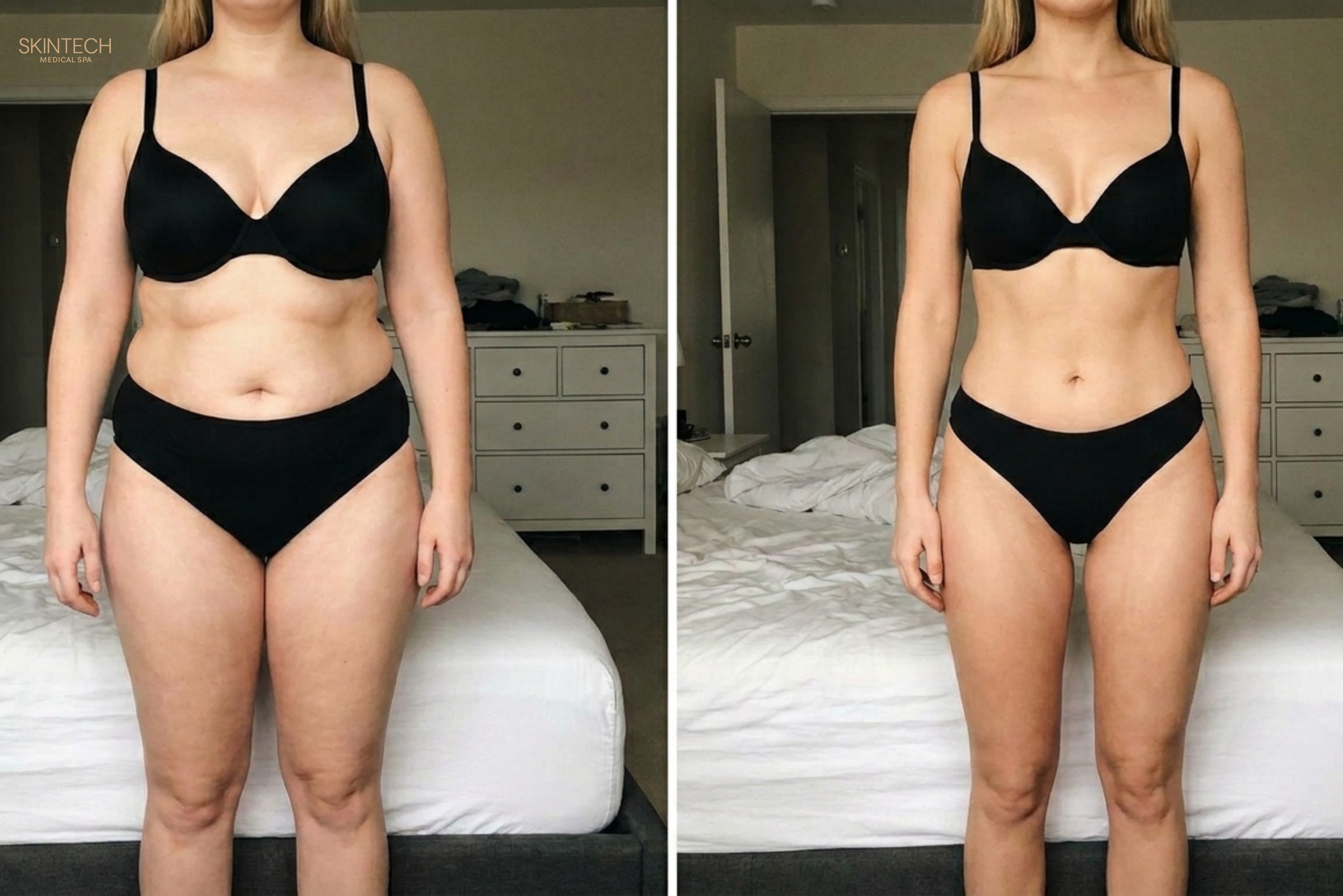 Mid-Section Makeover - Body Contouring (Bionexis) – Image 8