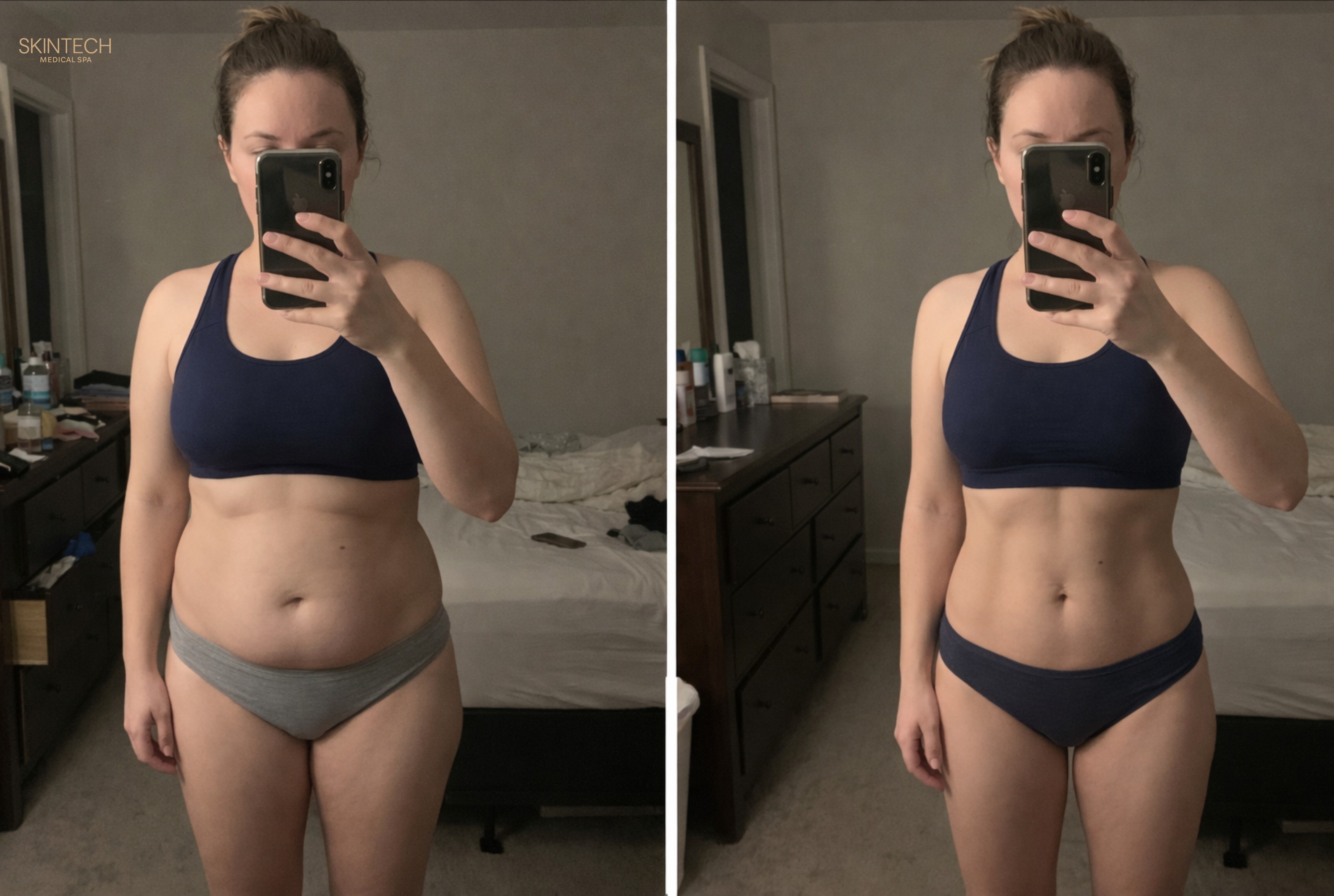 Mid-Section Makeover - Body Contouring (Bionexis) – Image 7