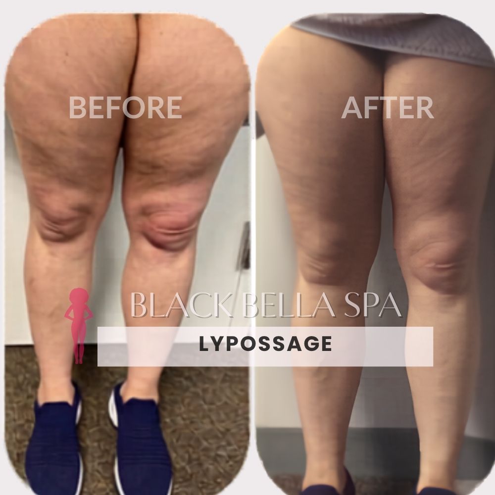Lypossage PK of 5 Full Body – Image 3