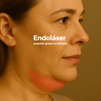 Endoláser Papada - Grasa localizada – Image 1