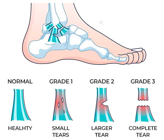 Ankle Injury First Aid – Image 3