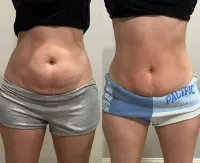 4 Sessions of Body Contouring – Image 2