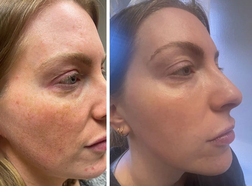 Undo the Sun - Lumecca IPL Photofacial – Image 2