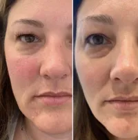 Undo the Sun - Lumecca IPL Photofacial – Image 3