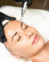 Glass Skin — Microneedling + Exosome Glow – Image 1