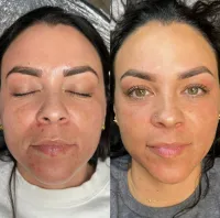 Glass Skin — Microneedling + Exosome Glow – Image 2