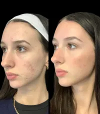 Glass Skin — Microneedling + Exosome Glow – Image 3