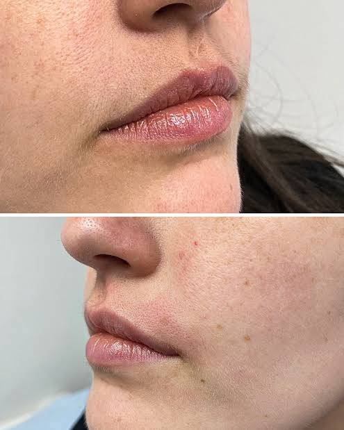 6 Full Face Laser  – Image 2
