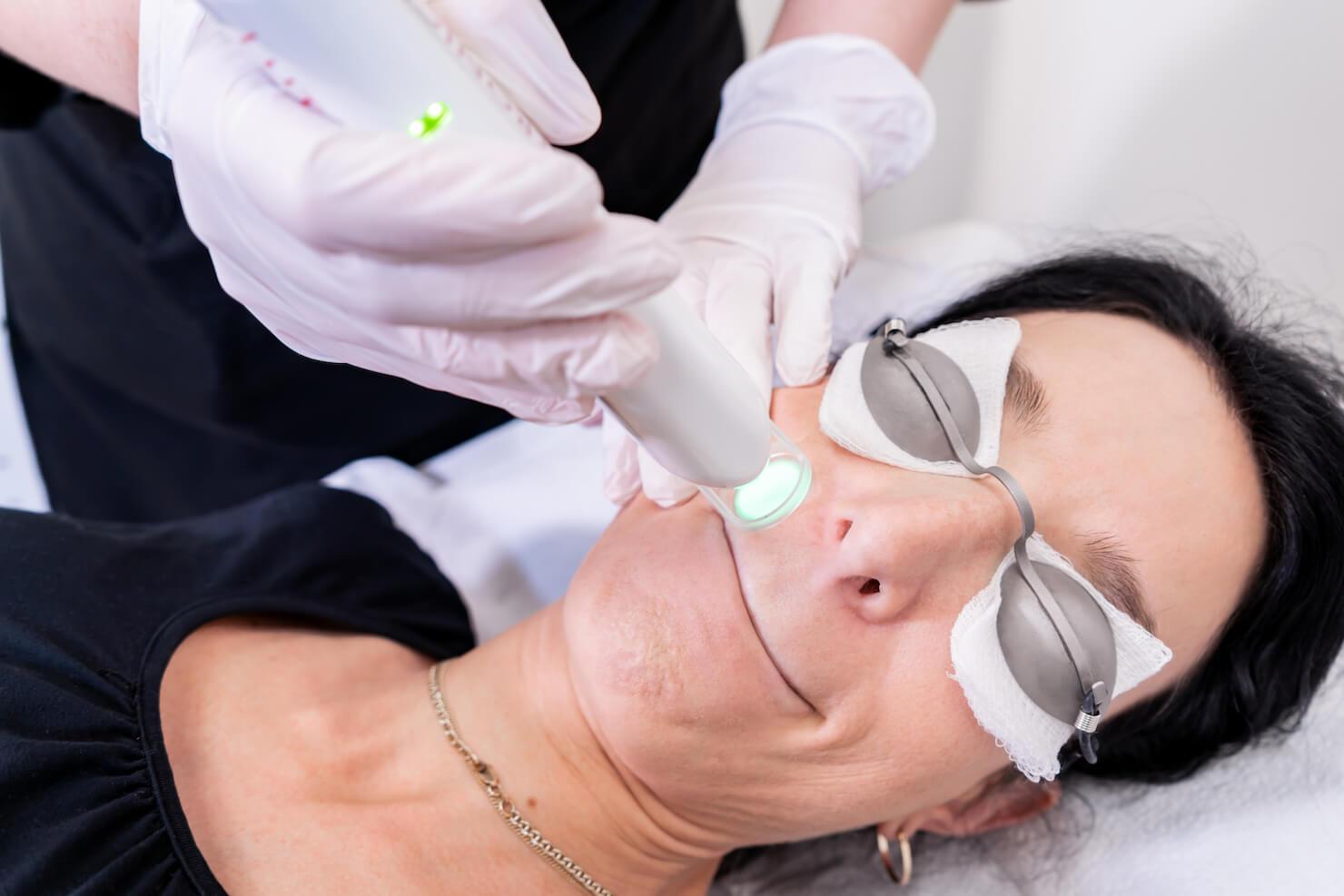 Upper Lip + Chin Package of 6 – Image 2