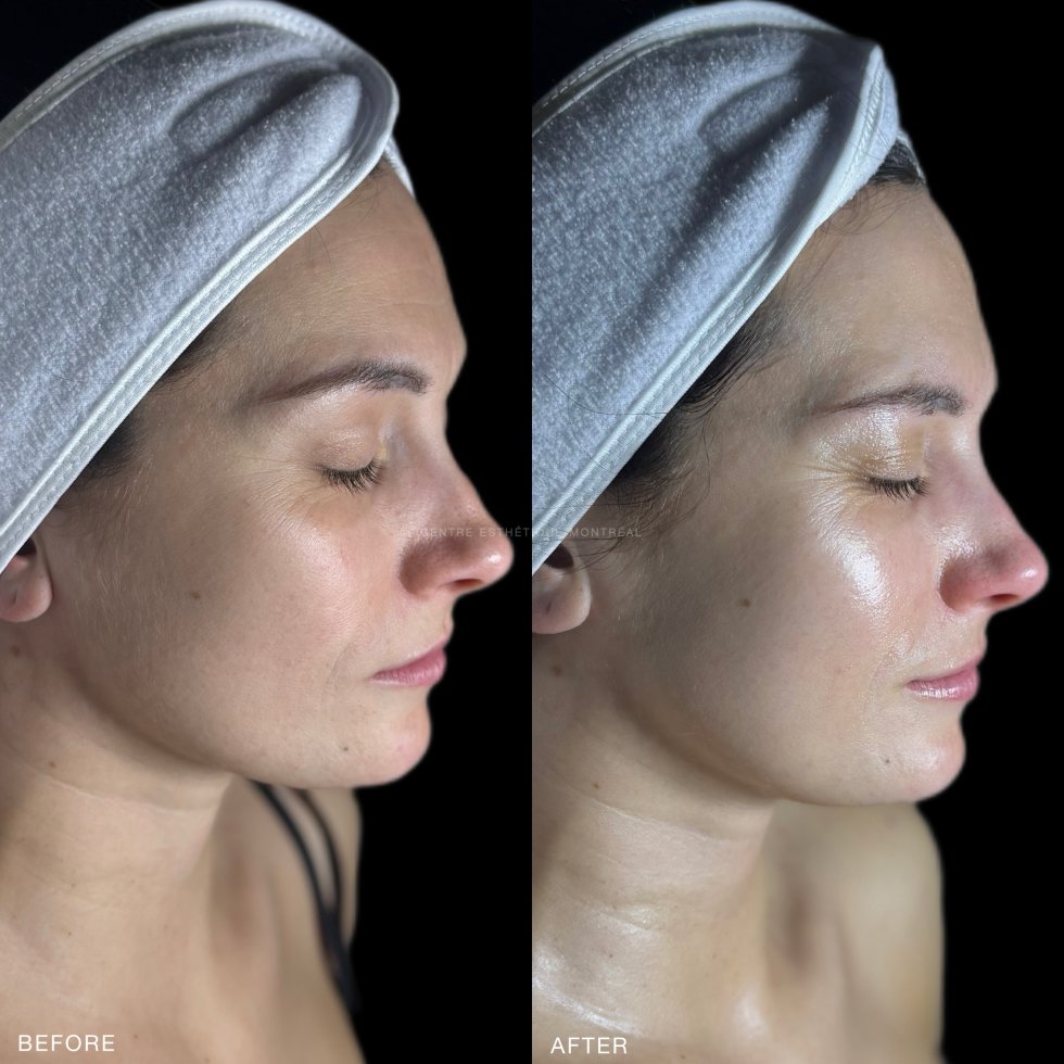 Chemical Peel Package of 3 – Image 2