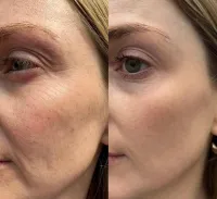 Lumecca IPL Face Package of 3 – Image 3