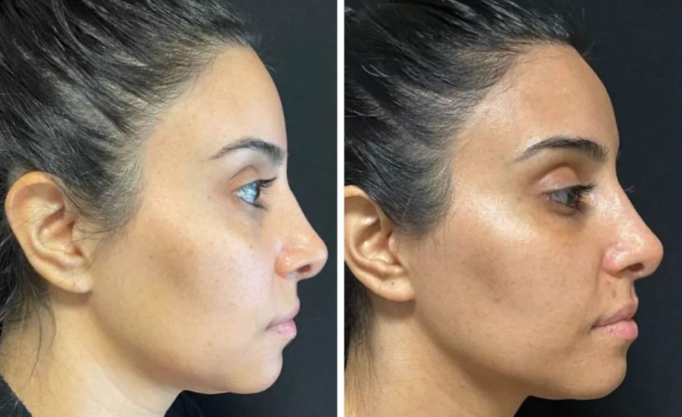 Jaw & Skin Tightening Duo – Image 2