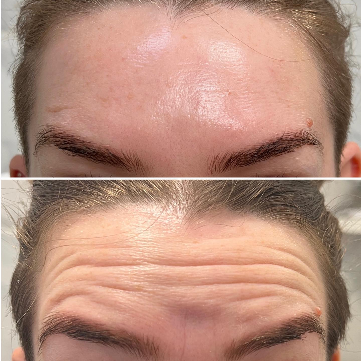 75 Units of Botox – Image 2