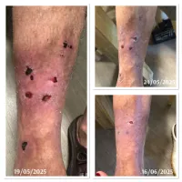 XO Derm - Home Use – Image 4