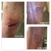XO Derm - Home Use – Image 5