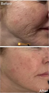 XO Derm - Home Use – Image 3