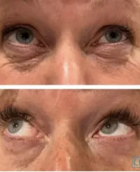 HEVATOX® Gold Eye Lift Cream  – Image 3