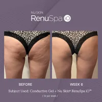 Nu Skin® RenuSpa iO™ – Image 3