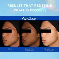 AviClear - Acne Solutions – Image 2