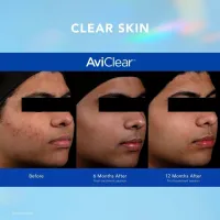 AviClear - Acne Solutions – Image 4