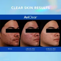 AviClear - Acne Solutions – Image 3
