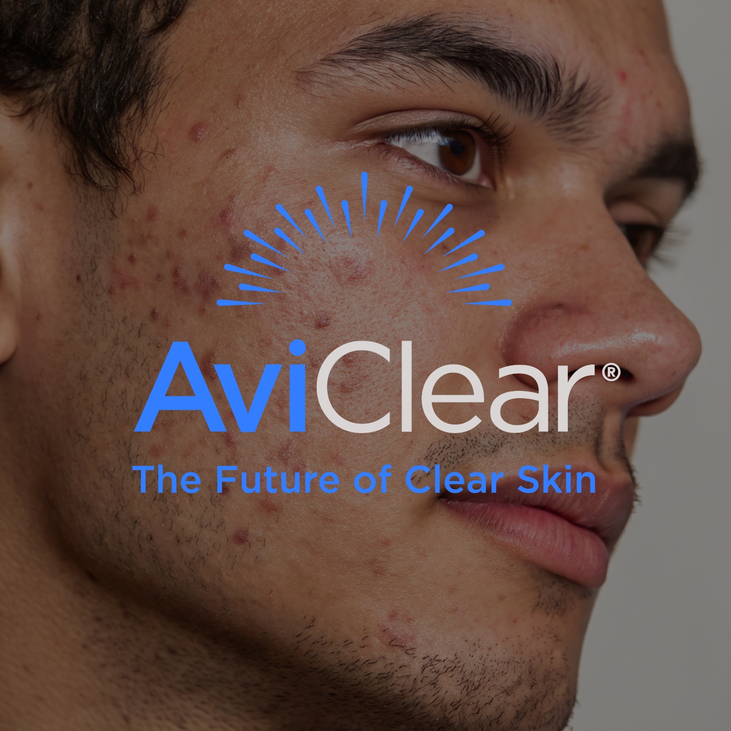 AviClear - Acne Solutions – Image 1