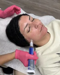 PRF or Rejuran Skin Booster SkinPen Microneedling – Image 1
