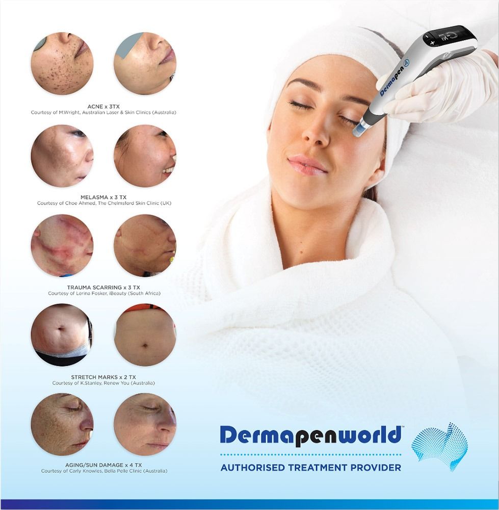 Microneedling + Exasome + LED Therapy – Image 2