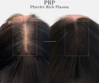 3 Sessions - PRP + Light Therapy – Image 2