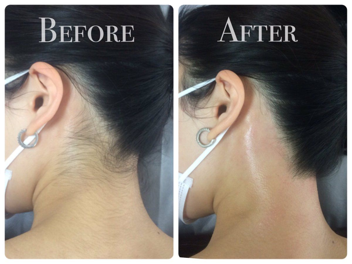 Laser Hair Removal  – Image 5