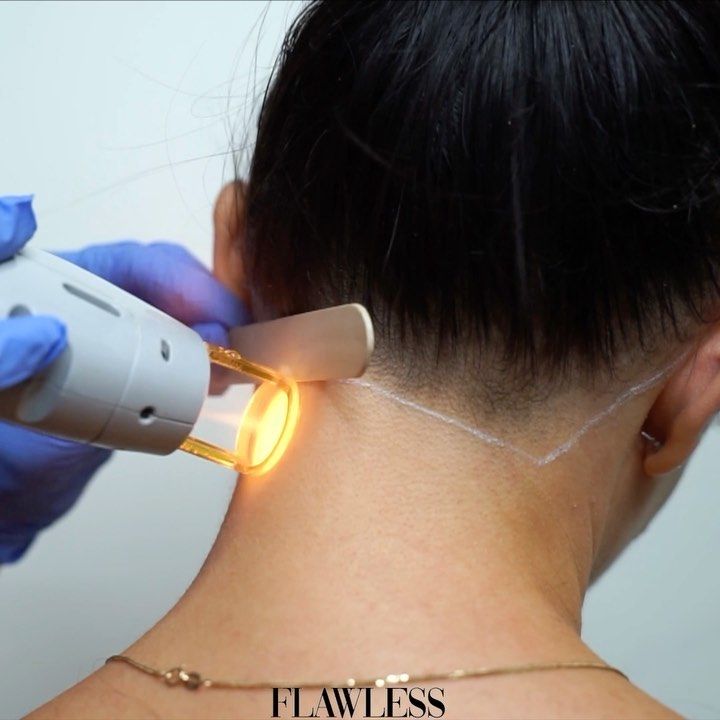 Laser Hair Removal  – Image 7