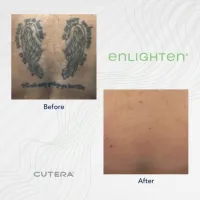 Cutera Enlighten III Tattoo Removal – Image 7