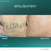 Cutera Enlighten III Tattoo Removal – Image 8