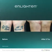 Cutera Enlighten III Tattoo Removal – Image 6