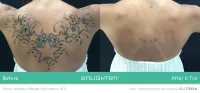Cutera Enlighten III Tattoo Removal – Image 4