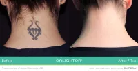 Cutera Enlighten III Tattoo Removal – Image 2