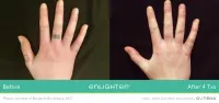 Cutera Enlighten III Tattoo Removal – Image 3