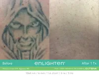 Cutera Enlighten III Tattoo Removal – Image 5