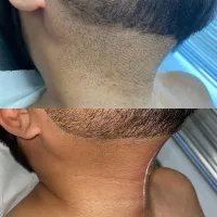 6 Sessions Beardline + Full Neck Laser Hair Removal – Image 3