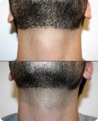 6 Sessions Beardline + Full Neck Laser Hair Removal – Image 4