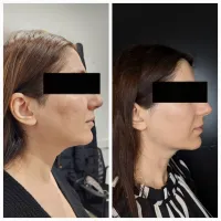 1 Jawline Sculpting session – Image 2