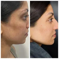 1 Jawline Sculpting session – Image 3