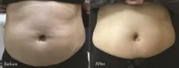 Stomach Tightening - Morpheus8 – Image 2