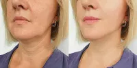 Jawline Sculpting Treatment – Image 3