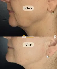 Jawline Sculpting Treatment – Image 5