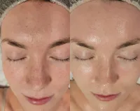 Korean Glass Facial  – Image 3